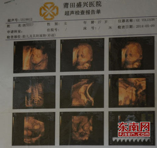 胎儿彩超报告单