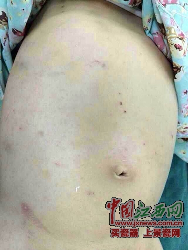 &ldquo;拉拉&rdquo;腹部多处针眼，肉眼清晰可见