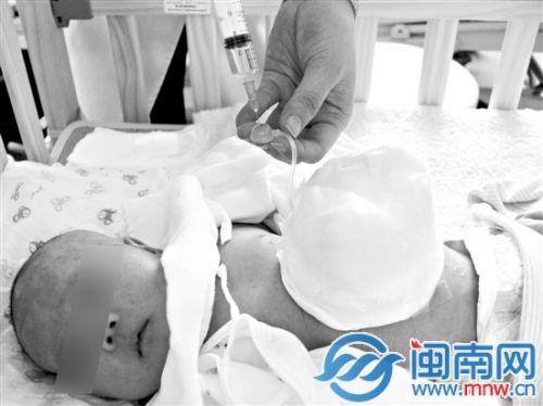 医生在Joy肚皮上接了一个人工贮袋和水袋，并往水袋里打入生理盐水，利用水的重量将器官一点点压回肚里