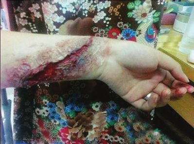 网友伪装出的“淤青”和“伤口”~