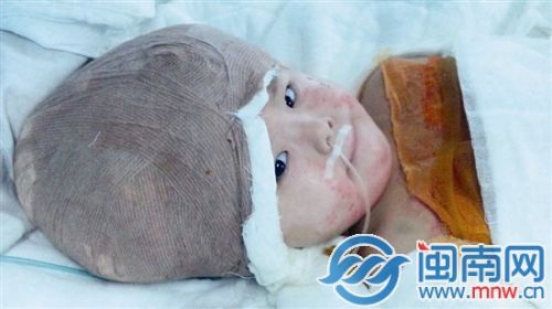 妞妞的第一次手术很成功