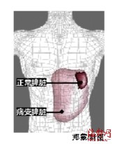 福州一男子患怪病 手术切下5公斤巨脾(图)