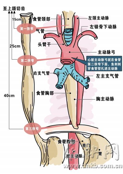 6旬男硬吞下2根鱼刺刺穿心脏主动脉 花十多万才保住命