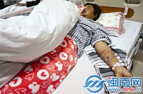 邹女士全身多处烫伤,右眼失明