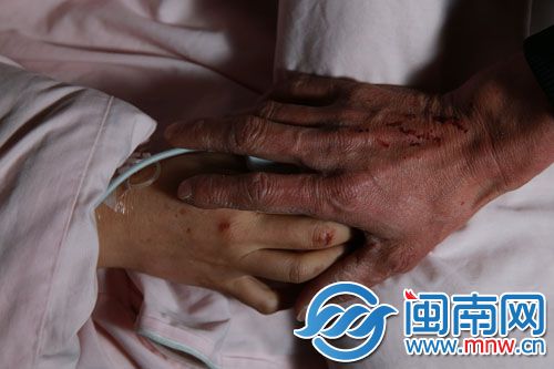 陈亮受伤的手，是妻子发病时抓伤的，但他还是一整夜抓着她的手