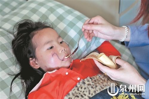 术后，小艳嘴巴无法用力嚼动，妈妈喂她吃香蕉。