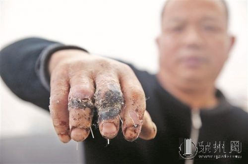 患者投诉泉州仁福医院中指无名指错接 已申请