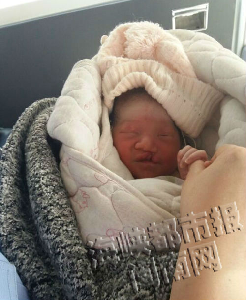 男婴患有轻微兔唇，只要做修补手术就可康复