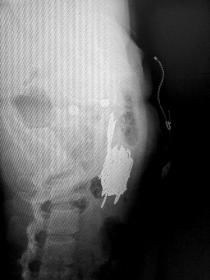 曲穎的x光片顯示，她的體內(nèi)有一捆剪刀。　記者杜方江攝