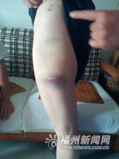 精神病人电梯内连砍女子6刀 伤者无大碍警方介入
