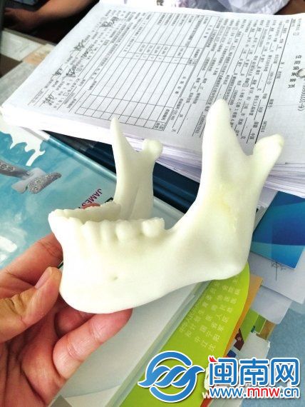 计算机重建后打印出来的下颌骨3D模型