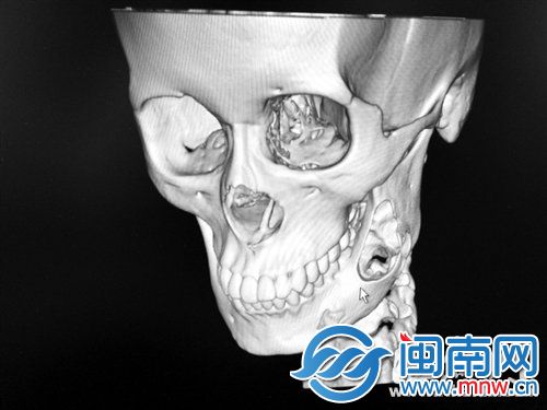 计算机的三维图像显示，小夏的骨头(画圈处)被肿瘤“吃”了