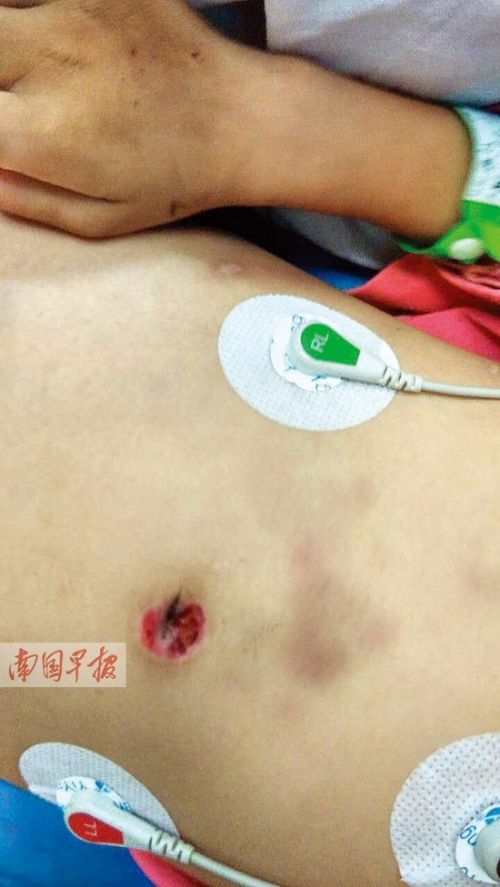 伤痕