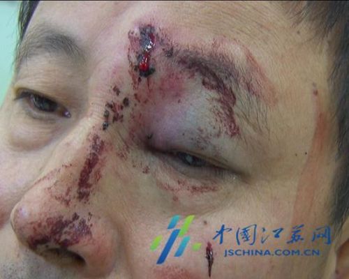 男租客伤势很严重