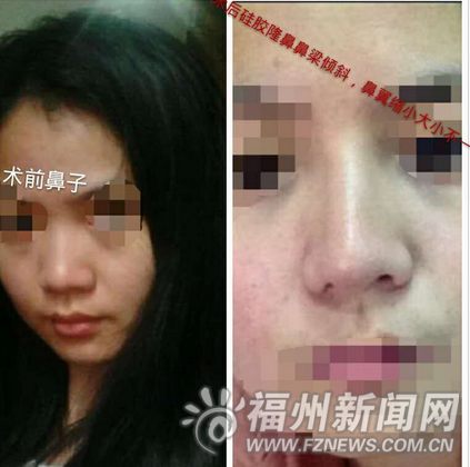 左为术前照片，右为术后照片，鼻孔一大一小。朱小姐供图