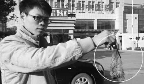 这块纱布遗留在阿红体内近半年。