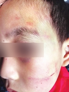 检查时（被打5天后），孩子脸上伤痕明显