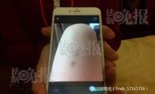 杨女士让法晚记者展示当时受伤的照片