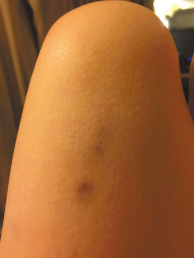 杨女士提供的照片显示,因反抗李某非礼造成其腿部淤青。京华时报记者韩林君摄