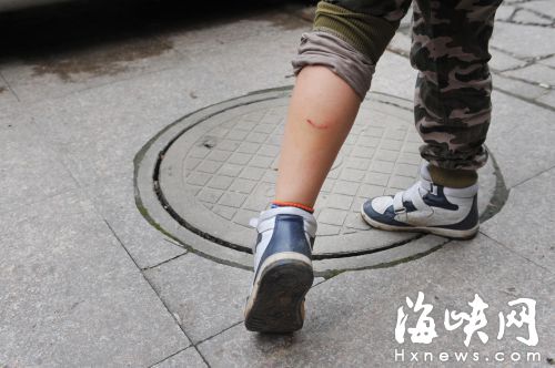 孩子的小腿上留下了一排牙印