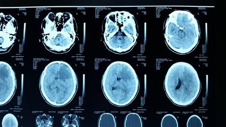 肿瘤信号是长t1长t2_耳朵后面长了个硬包是肿瘤吗？_肾上长肿瘤是恶性的吗