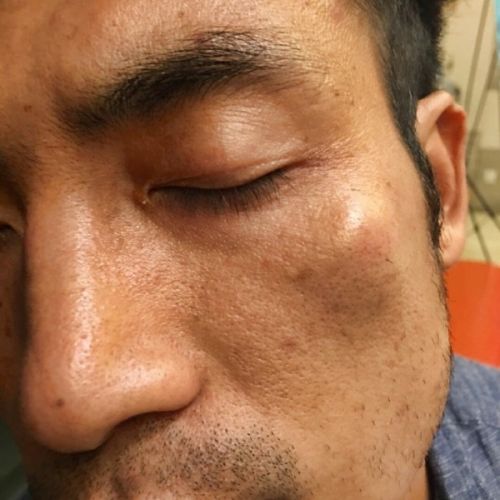  吴悠 :要让仗势欺人的人得到应有的惩罚 头部受