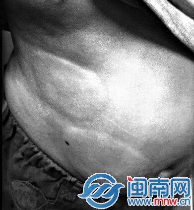 小明吃过螃蟹后脸色惨白、呼吸衰竭，身上还起了大片红疹子