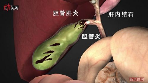 3D:吃鱼虾警惕肝吸虫病!我国感染人数超千万