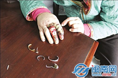 蔡阿婆右手食指、中指已潰爛