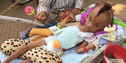 男孩头顶长裂缝  胎儿时曾被诊断有缺陷出生就有裂缝