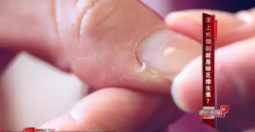 4岁女孩拔了根倒刺被截指 这个习惯很多人都有