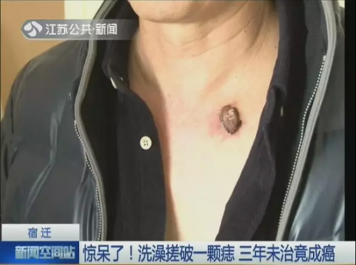 洗澡搓破痣竟成癌 基底细胞癌是什么有哪些症状？