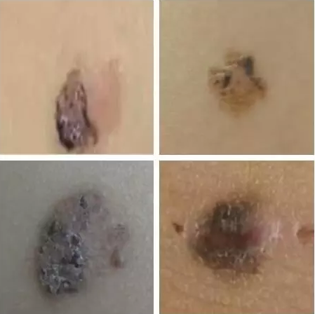 基底细胞癌可能表现为一颗痣、一片斑