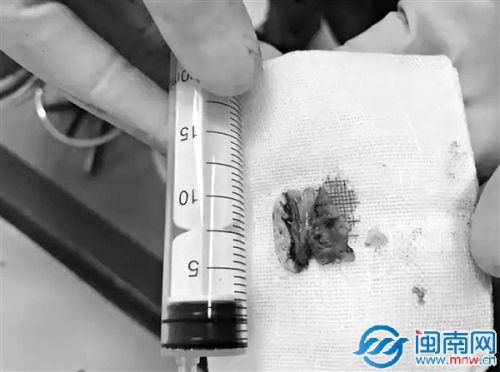 差点要了赖先生命的鱼鳃骨