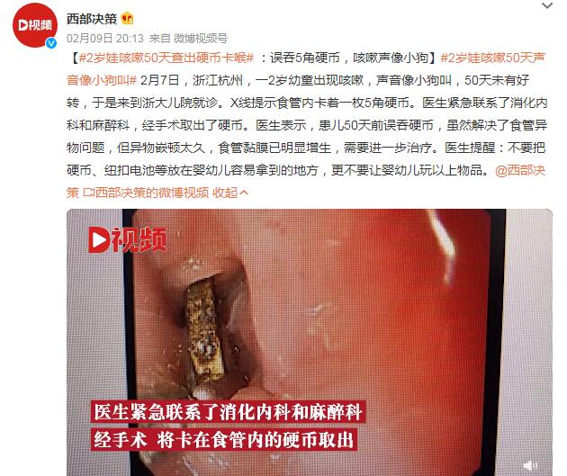 2岁娃咳嗽50天查出硬币卡喉 咳嗽声像小狗叫
