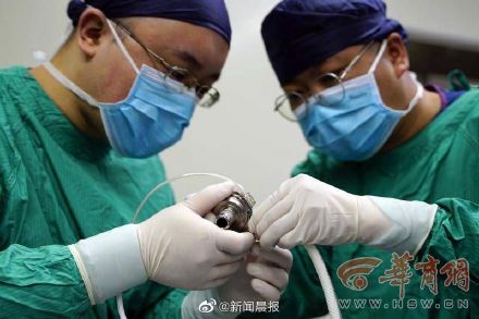 全国首例心脏不停跳人工心脏植入手术成功