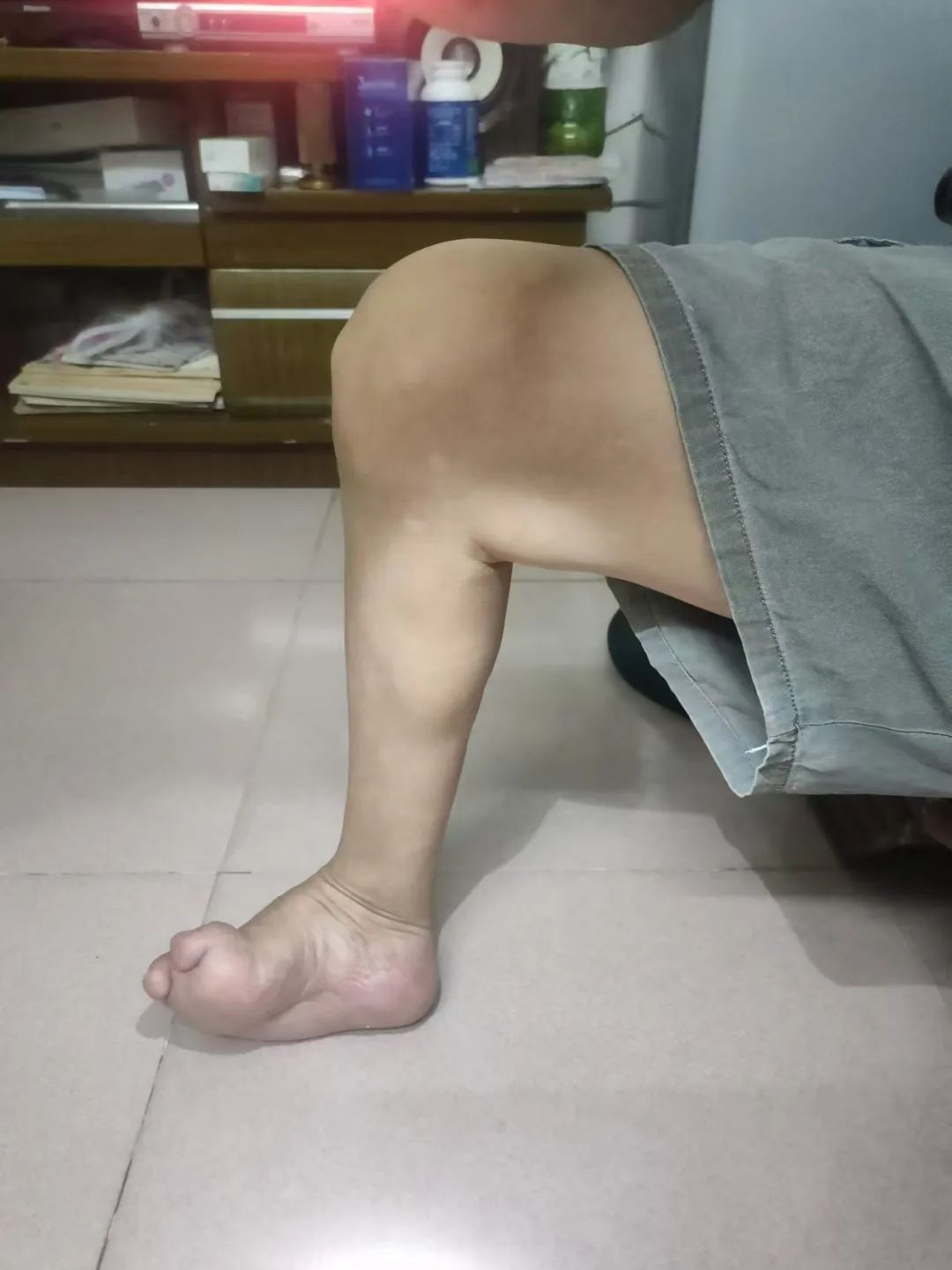精准矫形，步履重生！漳州第三医院骨科助创伤性马蹄内翻足患者“脚踏实地”
