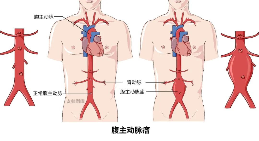 微创介入！漳州第三医院通过0.5-1cm微小创口化解腹主动脉瘤危机