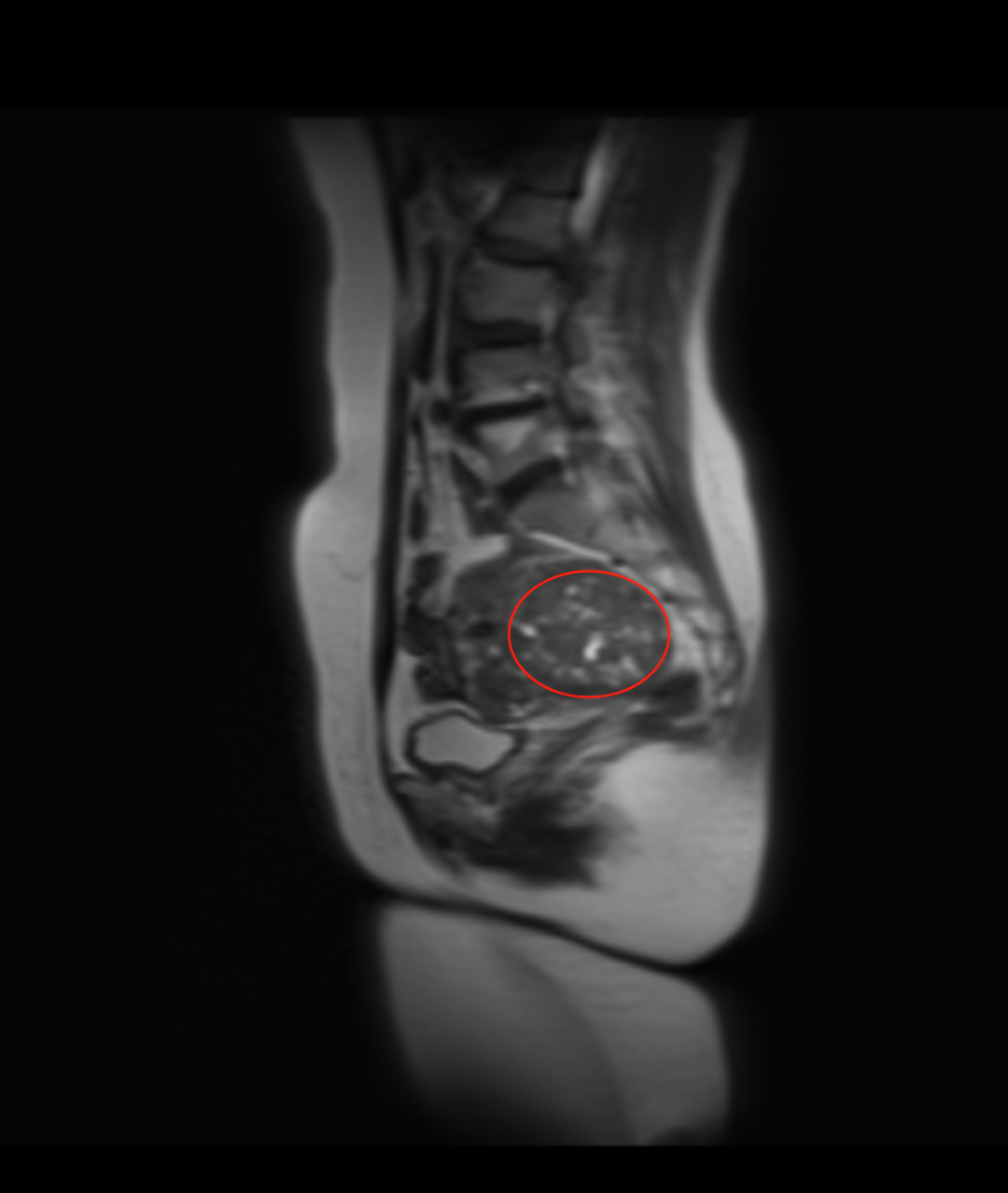 漳州第三医院：微创剔除肌瘤 守护女性健康