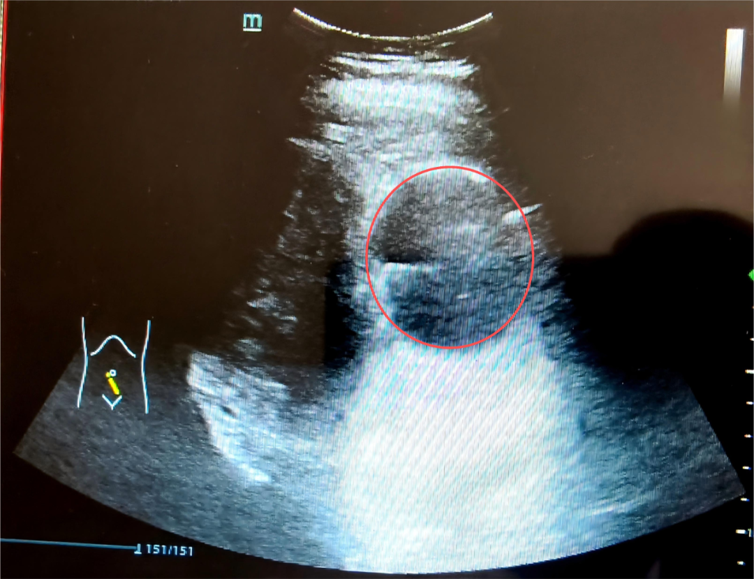 漳州第三医院精准护航，8.5cm巨大肌瘤下喜迎新生命