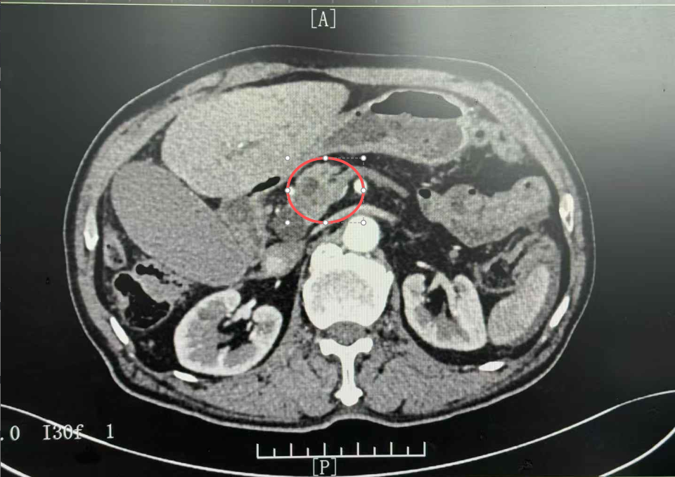 八旬老人胰头癌险阻重重 漳州正兴医院多学科协作护航生命