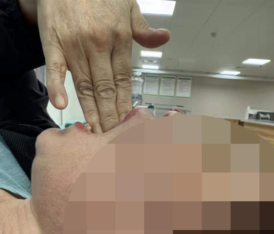 62岁阿姨张口受限伴疼痛半年余！漳州第三医院专业诊疗助力缓解疼痛