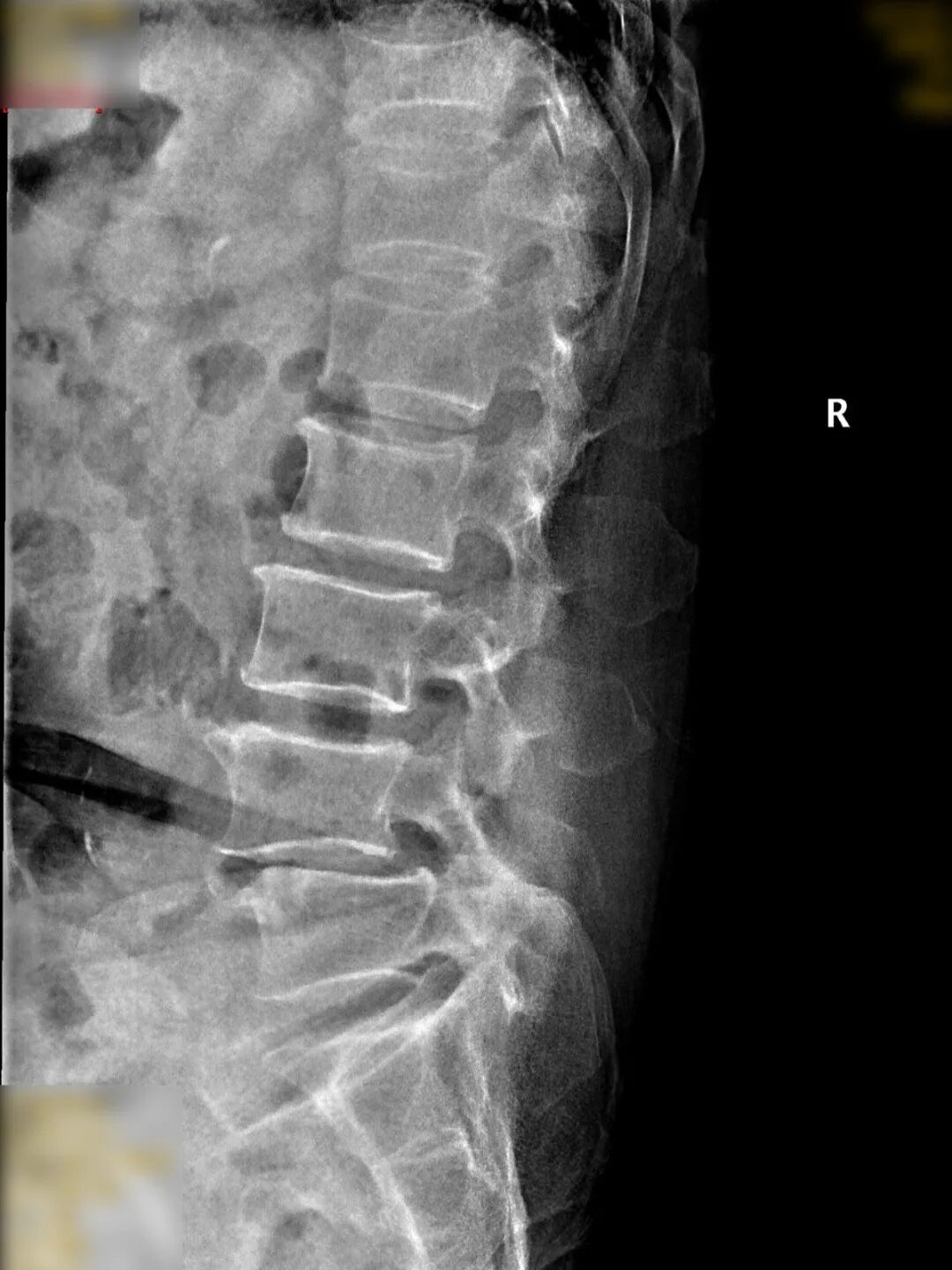 漳州第三医院：75岁老人怕开刀，结果医生几个小孔就搞定？