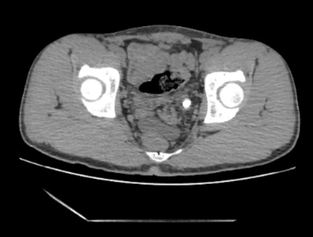 漳州第三医院：这种“触及灵魂的痛”，专盯不爱喝水的年轻人！