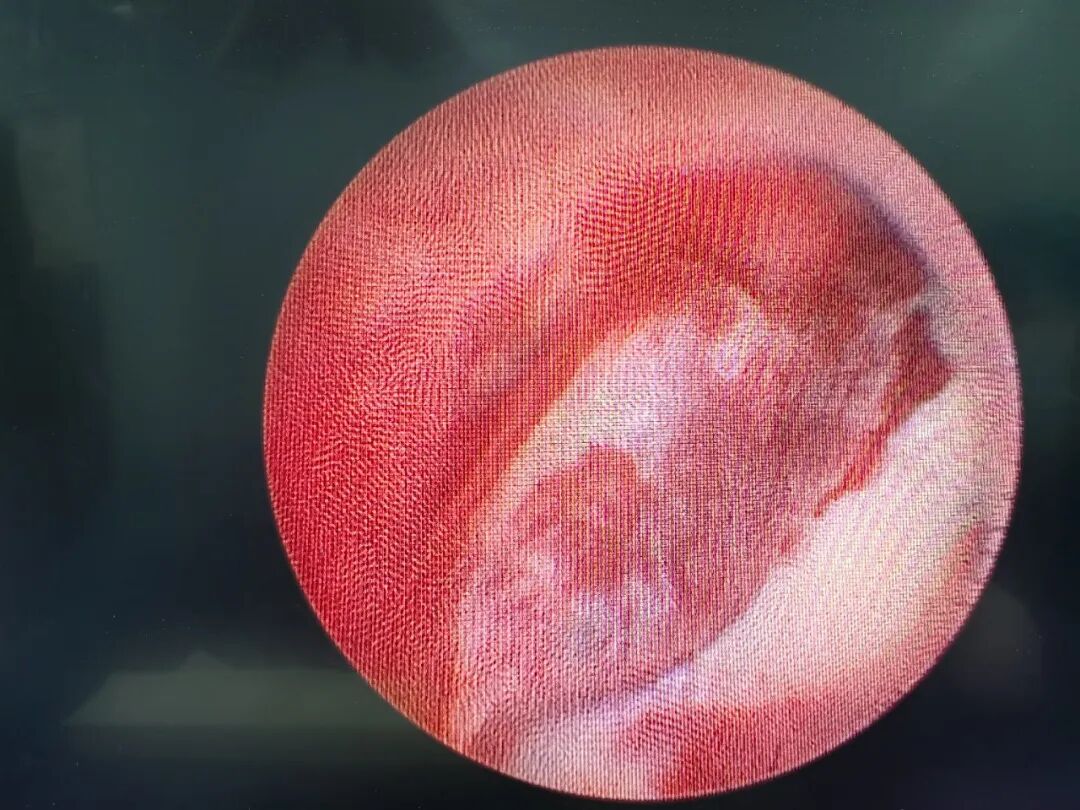 漳州第三医院微创内镜精准定位肾盂出血 六旬患者症状缓解