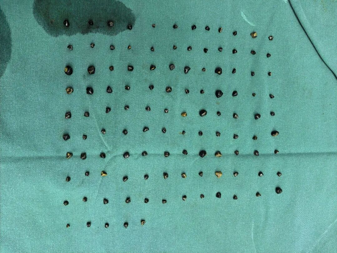 113颗结石藏体内？漳州第三医院专家微创手术解危情