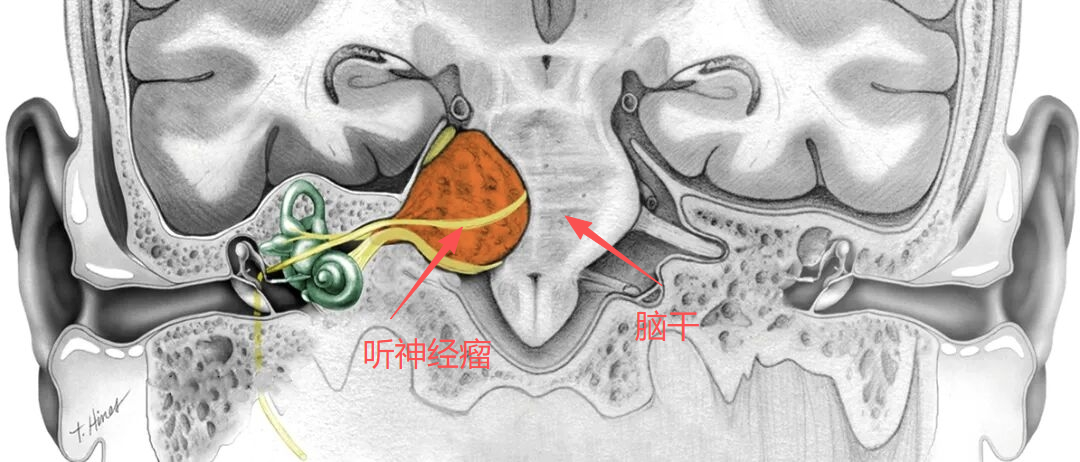 漳州第三医院：桥小脑角区巨大听神经瘤的精准手术实践