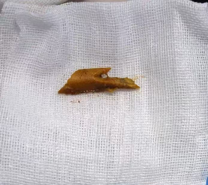 漳州第三医院：肛门里“藏”着异物 应及时到正规医院就诊