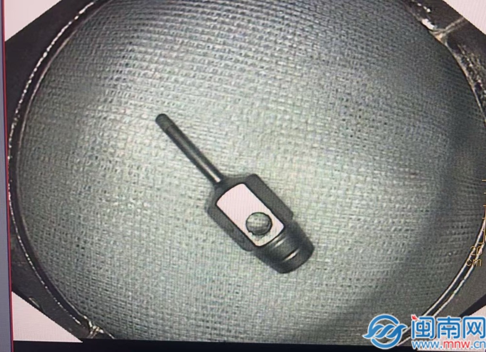 治牙时误吞牙科工具，医生内镜下轻巧取出