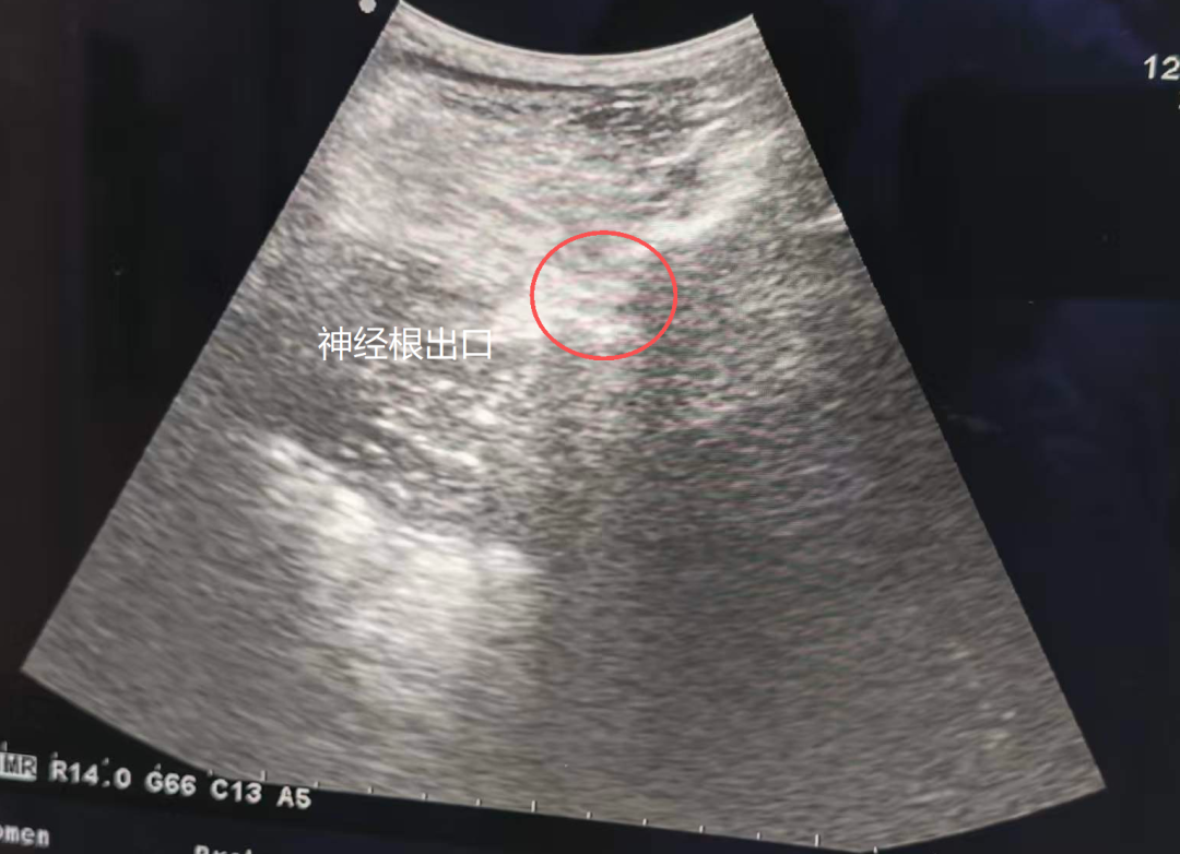 漳州第三医院：彩超引导精准治疗 缓解顽固带状疱疹神经痛